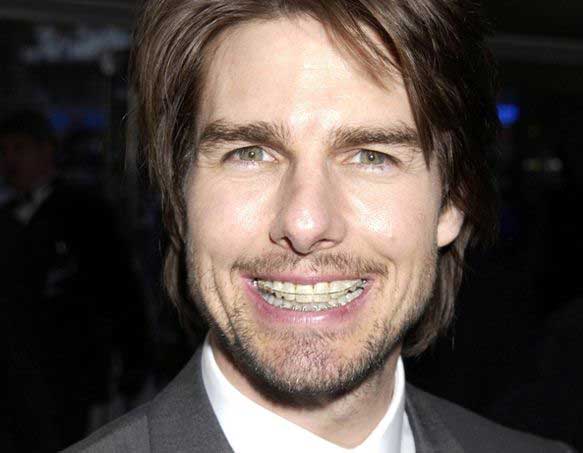 Tom Cruise Braces