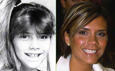 Victoria-Beckham-Bad-Teeth